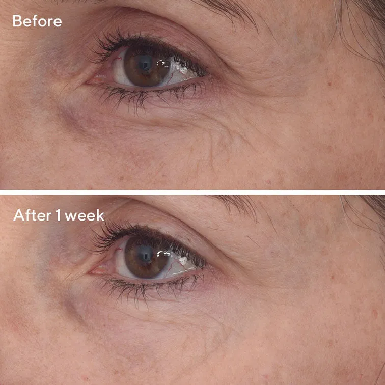 Retinal ReSculpt™ Eye Lift Treatment